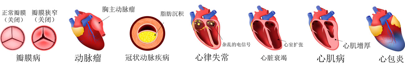 Types of heart disease in Chinese